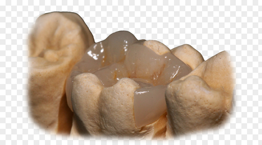 Slider Images Crown CAD/CAM Dentistry Inlays And Onlays Bridge PNG