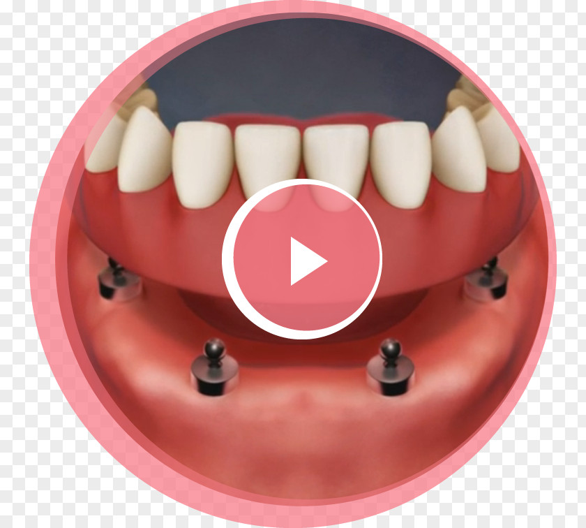 Implant Dentistry Tooth Dental Dentures Removable Partial Denture PNG