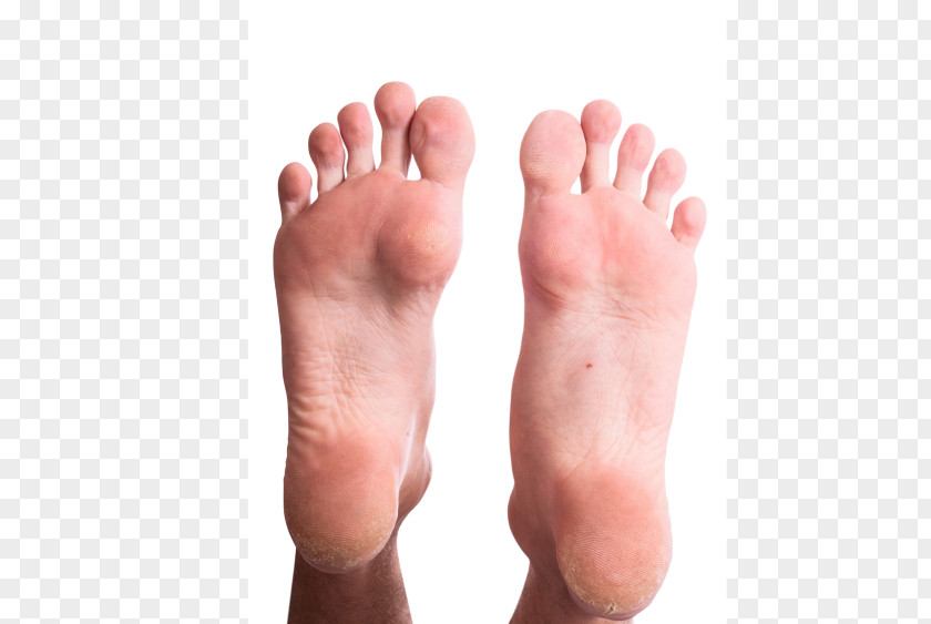 Corn Callus Podiatrist Foot Heel PNG