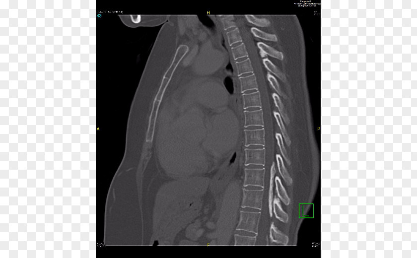 Swamy Radiology Autosomal Dominant Polycystic Kidney Disease Radiopaedia Medical Diagnosis PNG