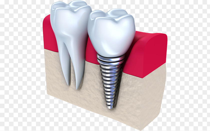 Crown Dental Implant Dentistry Tooth PNG