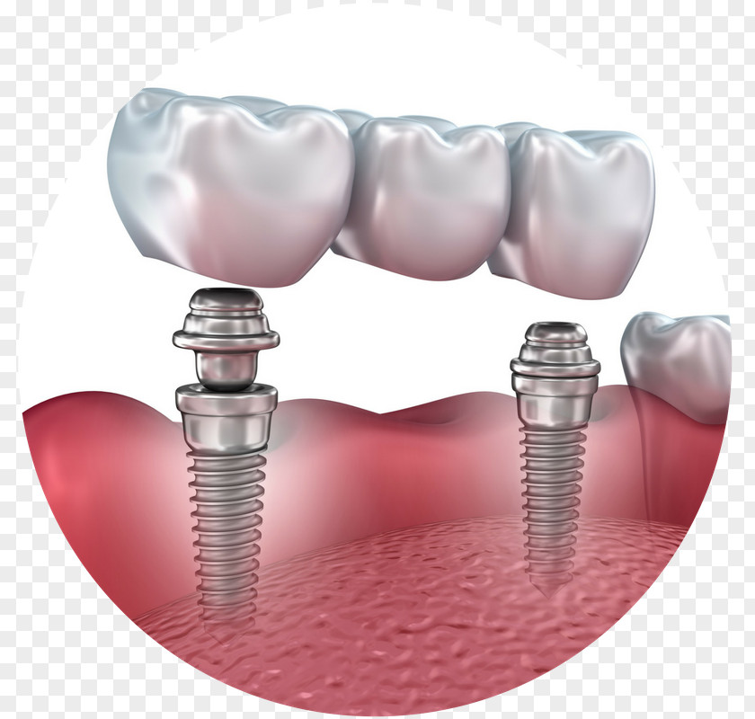 Bridge Dental Implant Dentistry Dentures PNG