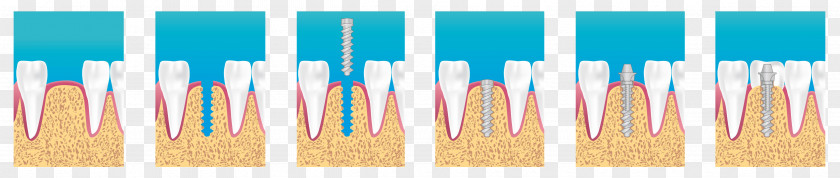 Implants Dental Implant Dentistry Surgery Bridge PNG