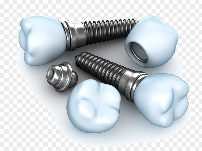 Dental Implant Dentistry Tooth PNG