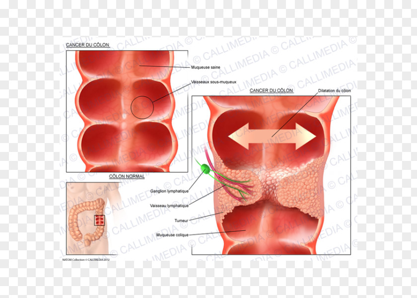 Colon Cancer Illustration Anatomique Ductal Carcinoma In Situ Oncology PNG