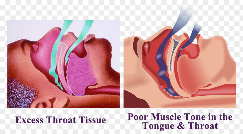 Sleep Disorder Snoring Obstructive Apnea Throat PNG