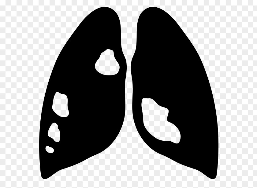 Lung Cancer Respiratory Disease PNG