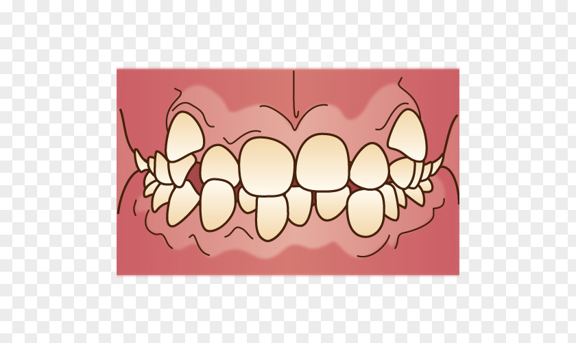 Orthodontics Dental Braces 矯正歯科 Dentist Mouthguard PNG