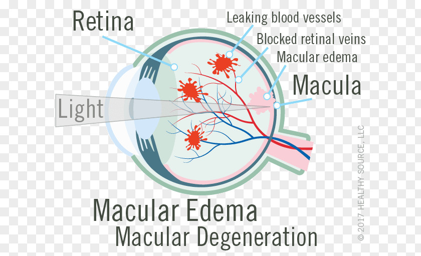 Eye Macula Of Retina Macular Edema Central Retinal Vein Occlusion PNG