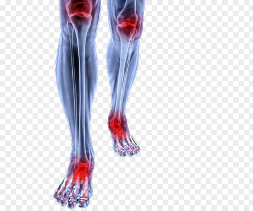 Knee Pain Podalgia Calf Sole PNG