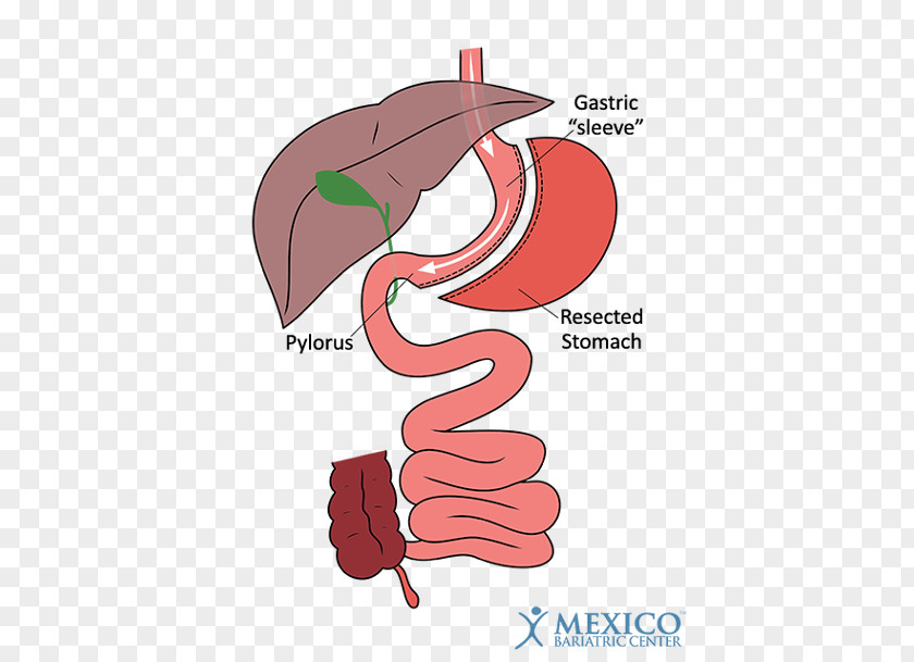 Sleeve Gastrectomy Duodenal Switch Bariatric Surgery Gastric Bypass PNG