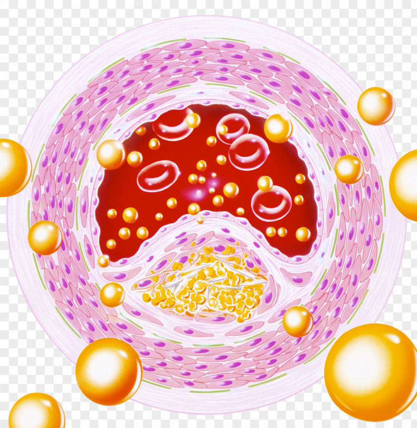 Blood Lipids Arteriosclerosis Vessel Artery Cardiovascular Disease Health PNG