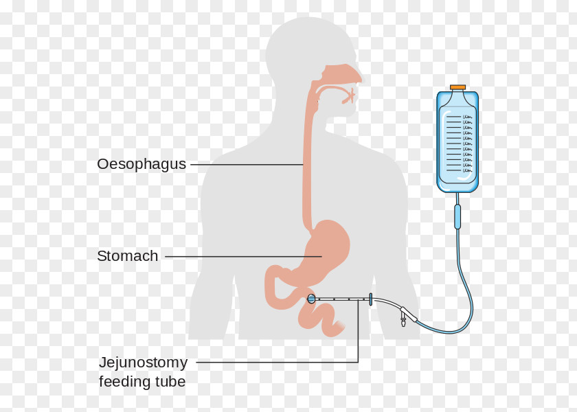 Small Intestine Jejunostomy Feeding Tube Percutaneous Endoscopic Gastrostomy Nasogastric Intubation PNG
