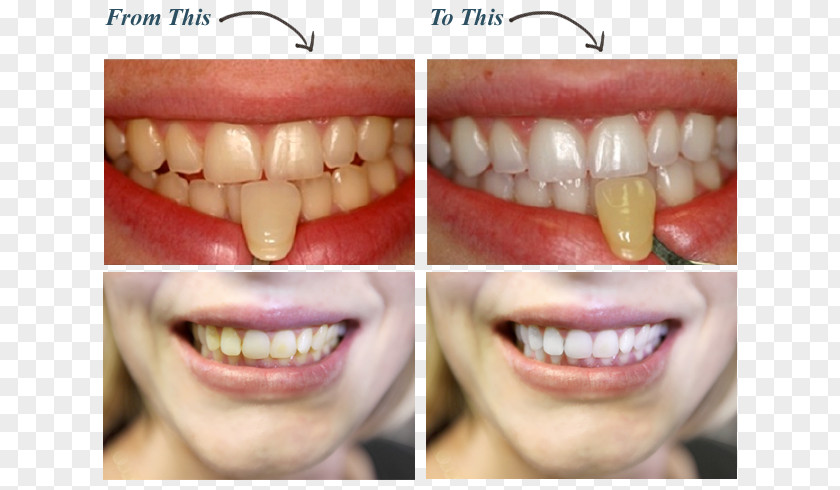 Dentist Tooth Whitening Dentistry Human PNG