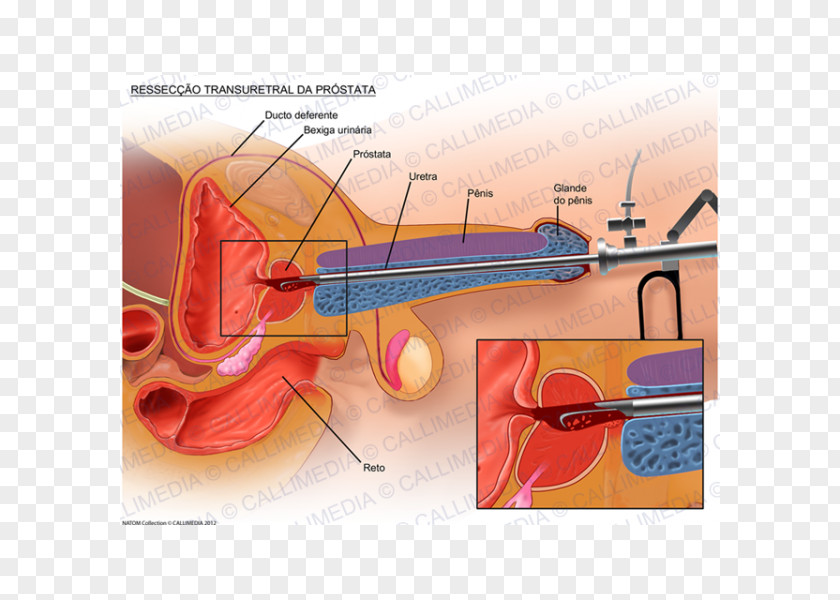 Prostate Gland Transurethral Resection Of The Surgery Cancer PNG