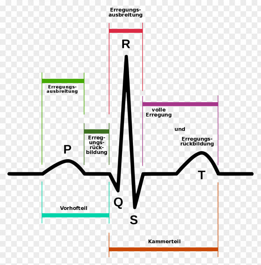 3lead Ekg Electrocardiography Heart Arrhythmia Signal Processing Atrial Fibrillation PNG
