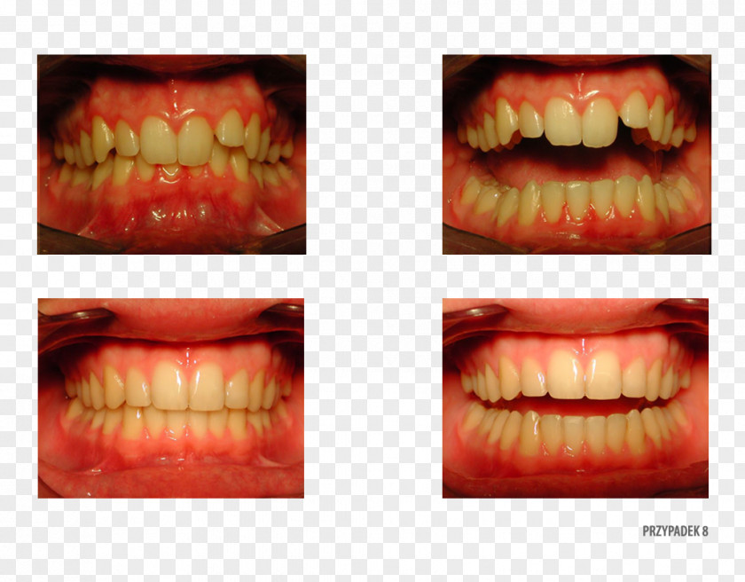 Tooth Camera Therapy Orthodontist Patient PNG