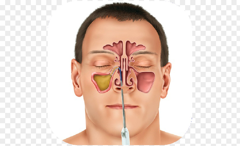 Health Sinus Infection Paranasal Sinuses Therapy Toothache PNG