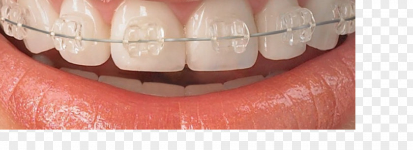 Dentist Tooth Whitening Damon System Weber Orthodontics Dental Braces Dentistry PNG