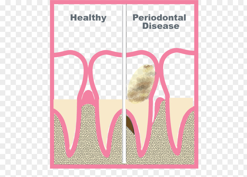 Periodontology Periodontal Disease Periodontium Gums Tooth PNG