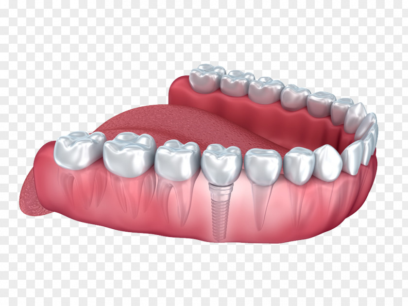 Dental Implant Human Tooth Dentistry PNG