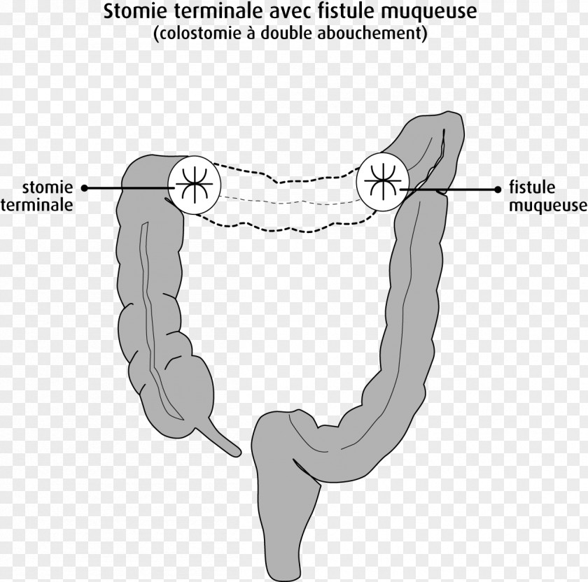 Day To End Obstetric Fistula Large Intestine Ileostomy Colostomy Rectum Colorectal Cancer PNG