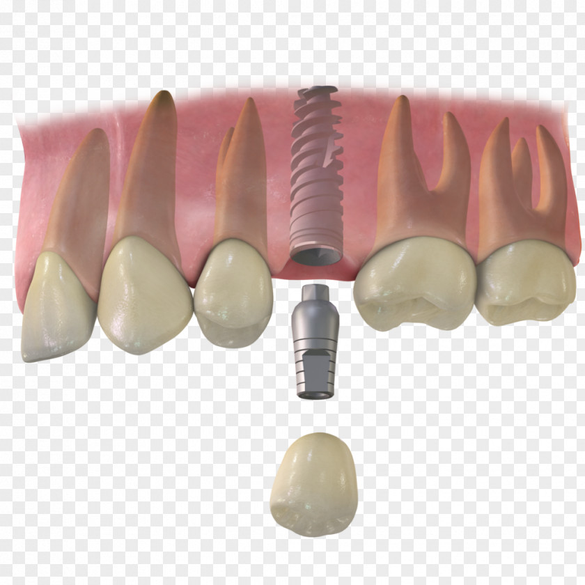 Dental Implant Cabinet Tooth Dentistry Implantology PNG