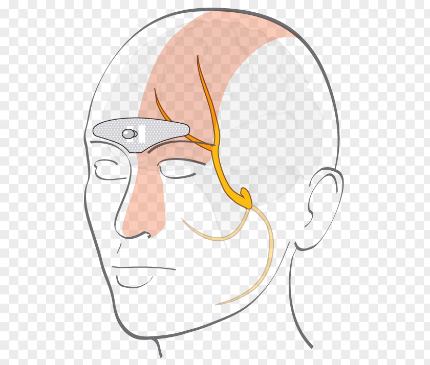 Ear Forehead Cefaly Electrode Migraine PNG