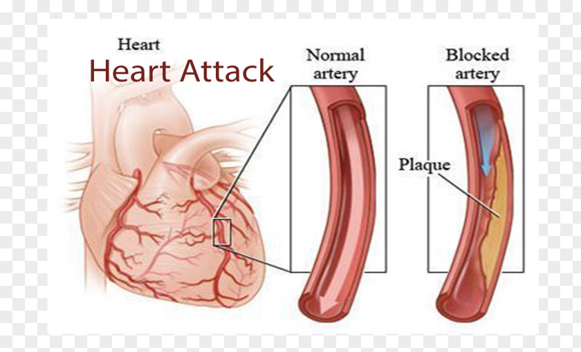 Heart Coronary Artery Disease Arteries Cardiovascular PNG