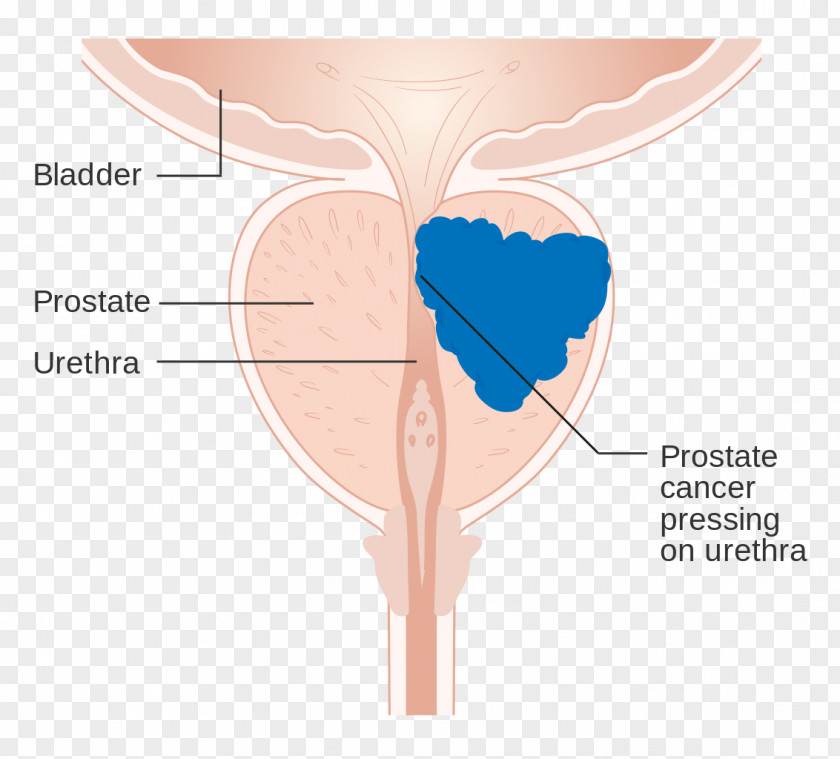 Health Prostate Cancer Gland Urology PNG