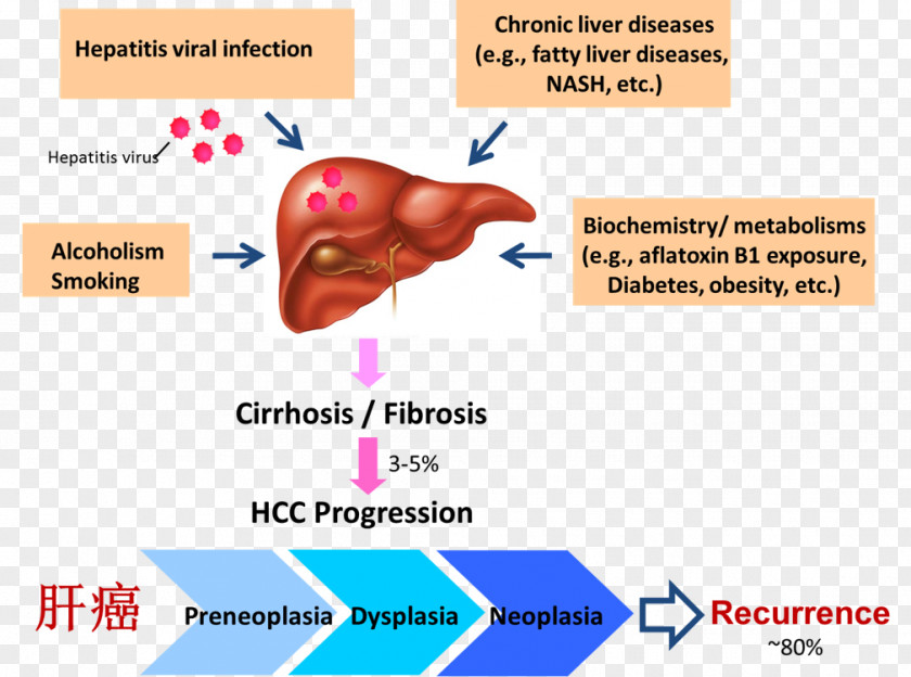 Liver Disease Cancer Hepatocellular Carcinoma Fibrosis PNG