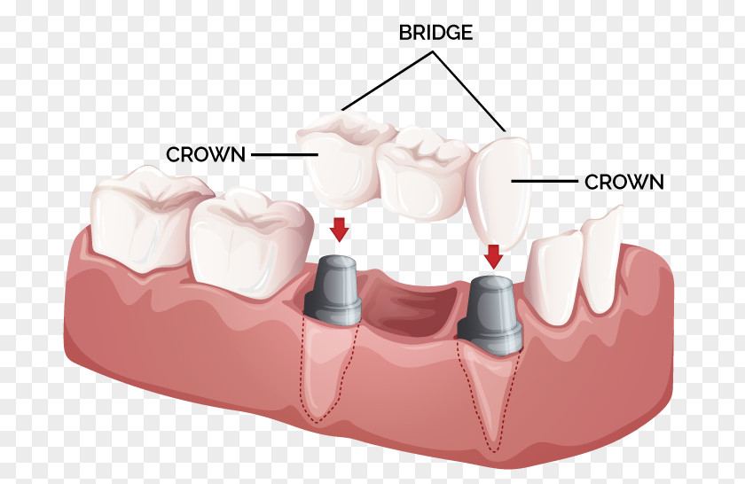 Dental Postcard Bridge Crown Dentistry Implant PNG