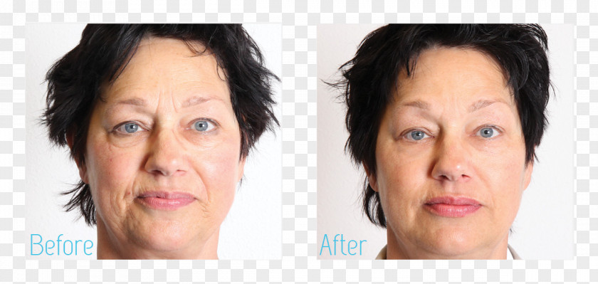 Face Therapy Rhytidectomy Facial Skin PNG