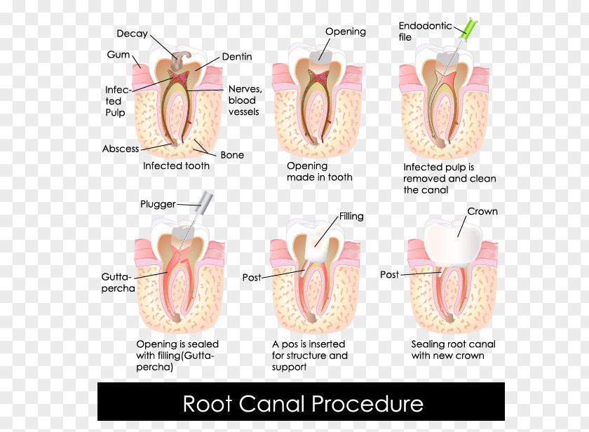 Crown Endodontic Therapy Root Canal Dentistry PNG