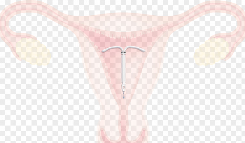 Intrauterine Device Kyleena Uterus Progestin IUD Levonorgestrel PNG device Levonorgestrel, sperm condom clipart PNG