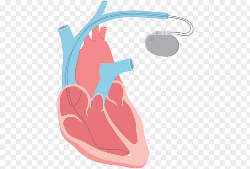 Heart Beat Faster Arrhythmia Clip Art Tachycardia Catheter Ablation PNG