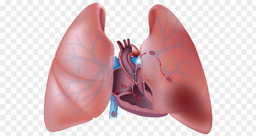 Chronic Obstructive Pulmonary Disease Embolism Thrombus Artery Embolus Lung PNG