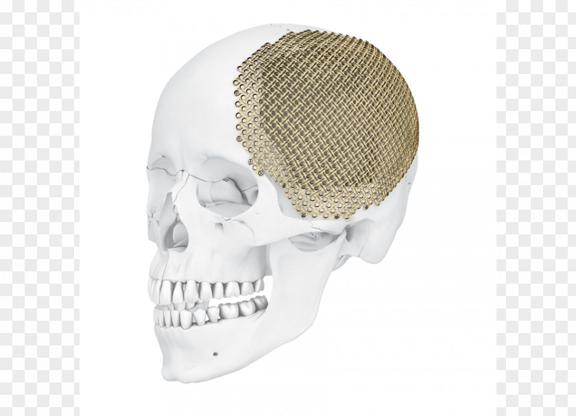Skull Implant Surgical Mesh Surgery PNG