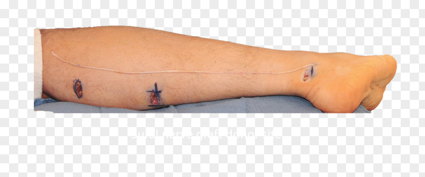 Cross Legged Sural Nerve Allograft Arteries PNG