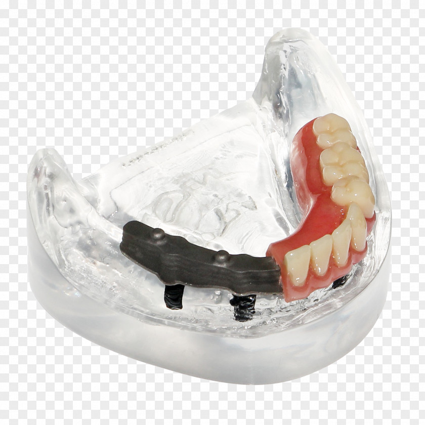Braces With Partial Dentures Tooth Made, Netherlands Digital Data .be PNG