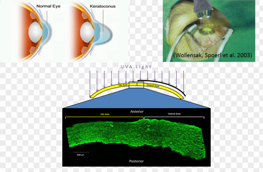 Earlyonset Alzheimer's Disease Biomechanics Organism Tissue Dental Implant PNG