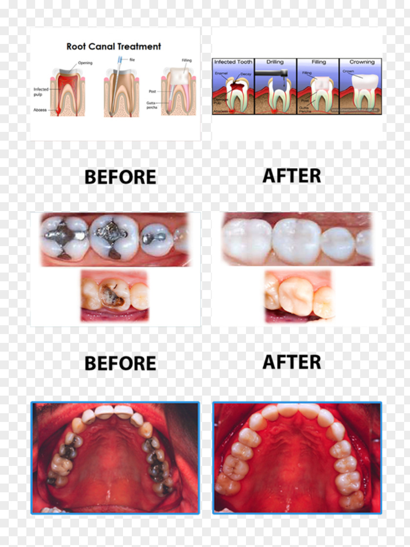 Surgery Dentistry Root Canal Dental Extraction PNG