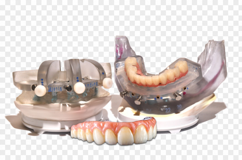 Tooth NDX NSequence Dental Laboratory Dentistry Implant PNG