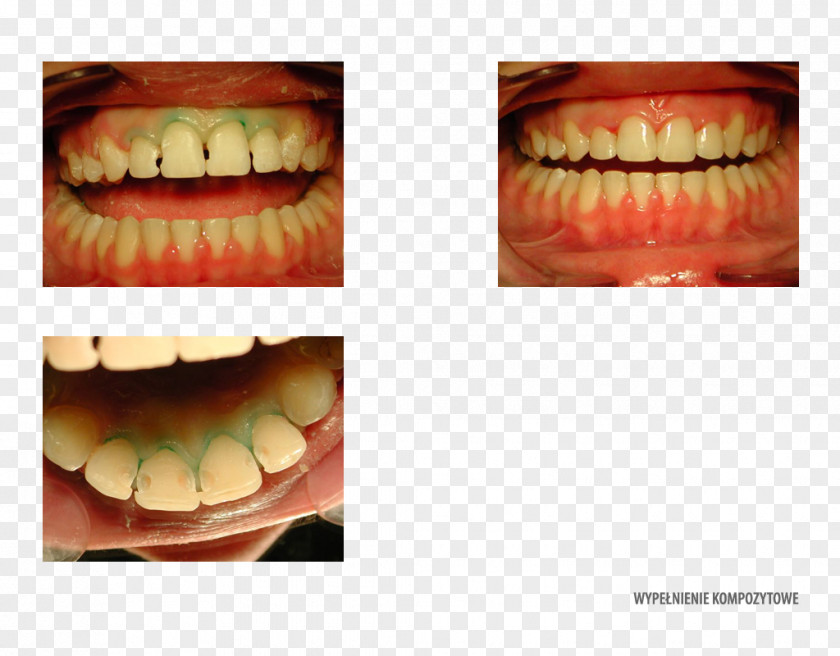 Orange Tooth Decay Dentistry Orthodontics PNG