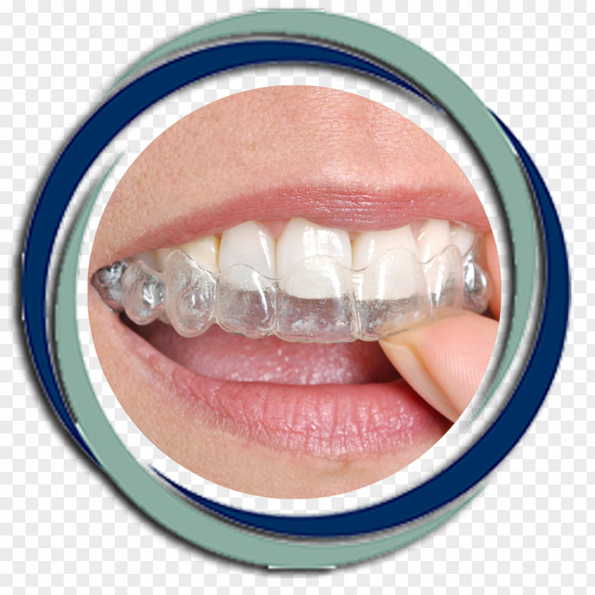 Clear Aligners Dental Braces Orthodontics Dentistry Tooth PNG