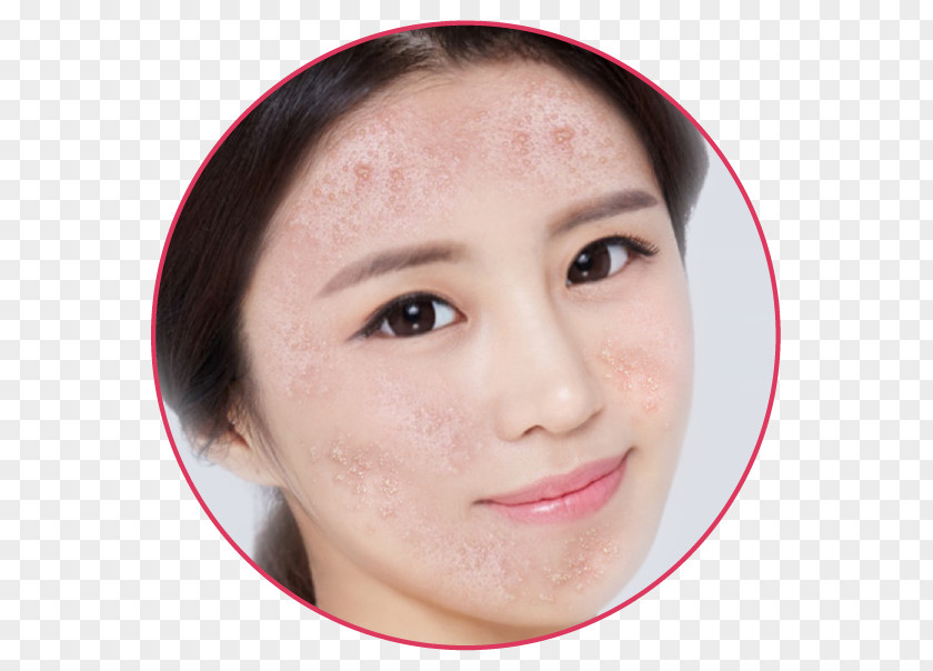 Chuồn Mụn Eyebrow Acne Forehead Skin Care PNG