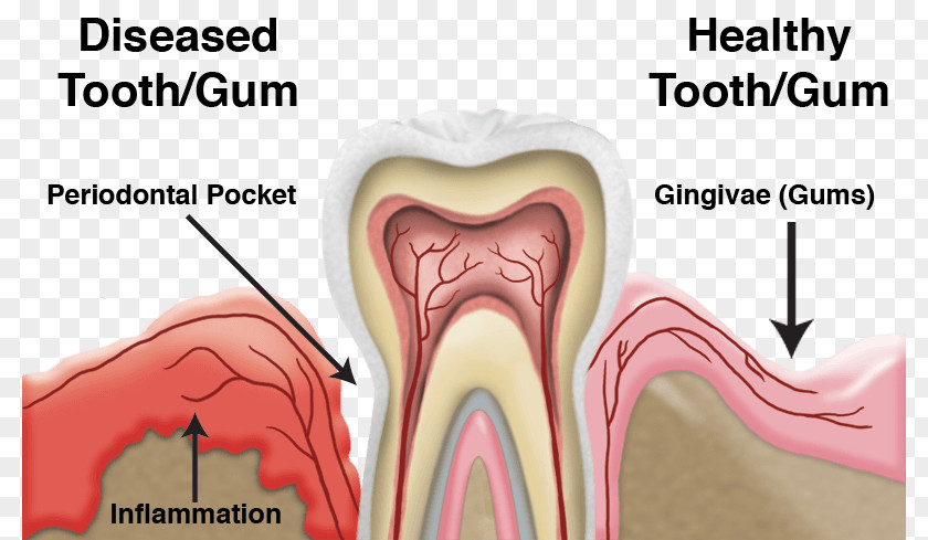 Health Tooth Periodontal Disease Dentistry Gums PNG