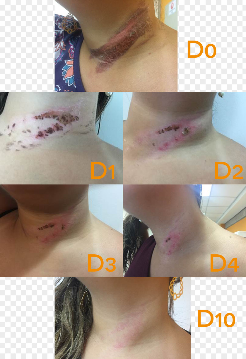 Tratamento Feridas Burn Wound Scar Lesion Patient PNG