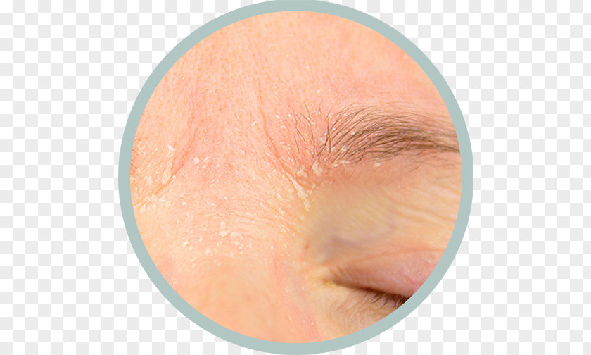 Eyelids Seborrheic Dermatitis Cutaneous Condition Itch Skin PNG