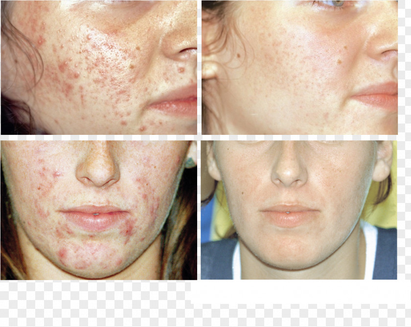 Chemical Peel Cheek Chin Forehead Jaw Mouth PNG